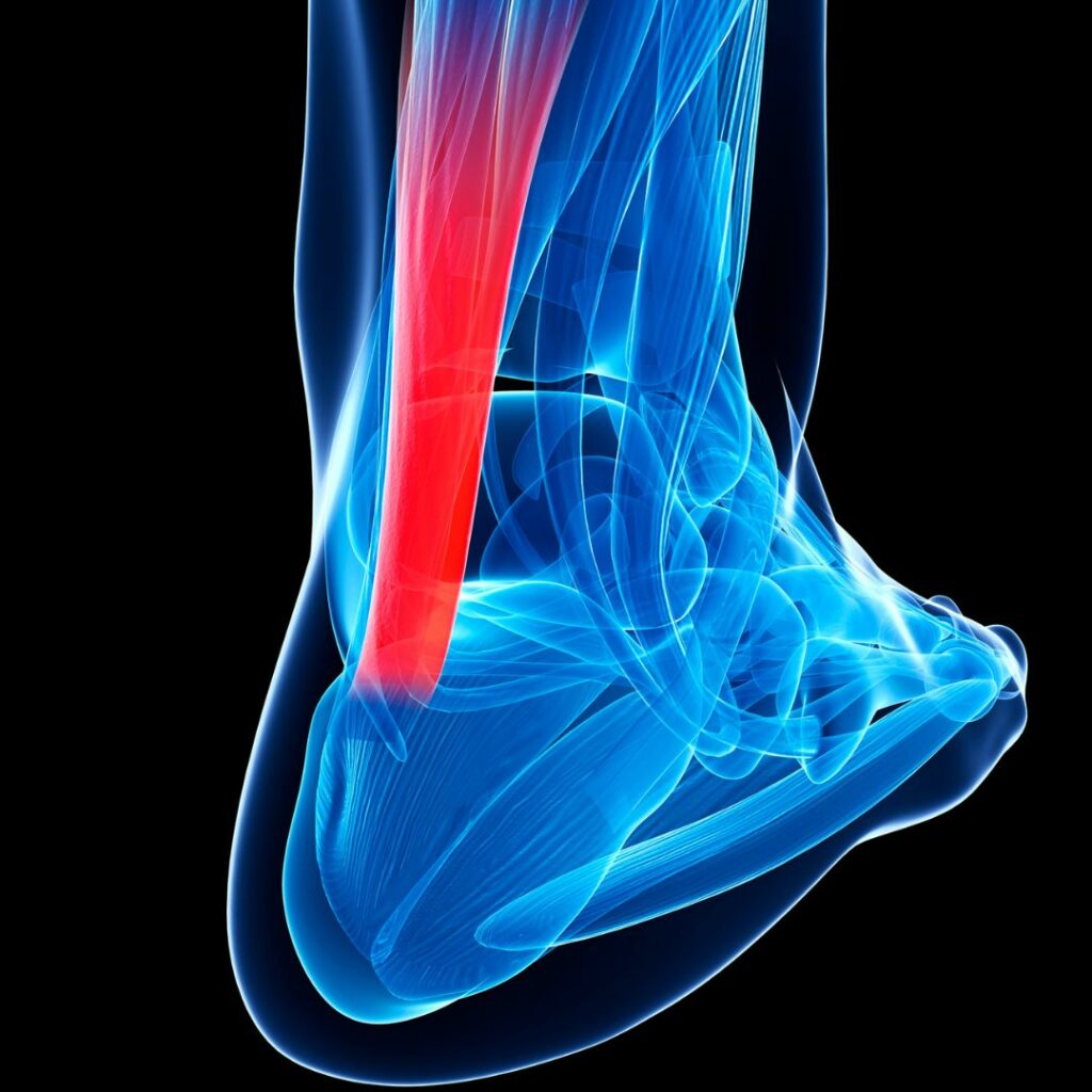 What causes overuse injuries in tendons? Inadequate recovery and doing too much, too soon. 