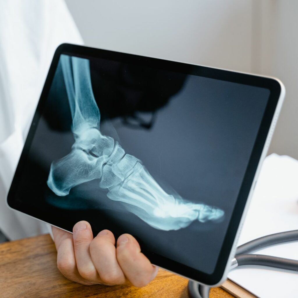 Repetitive, novel, high force activities are part of what causes overuse injuries, which can manifest as stress fractures in bones.