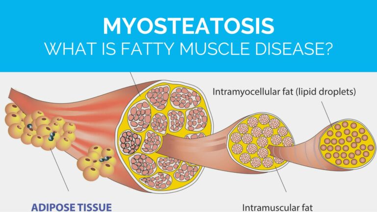 Myosteatosis What is fatty muscle disease